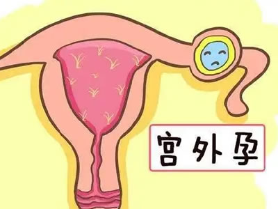 警惕！這些女性更易患宮外孕
