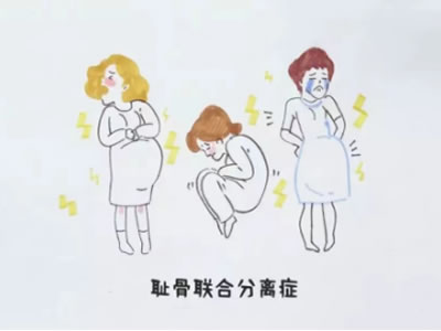 孕媽媽的難言之痛——讓小運動解決大問題