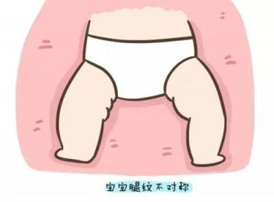 寶寶腿紋、臀紋不對稱，就是髖關(guān)節(jié)發(fā)育不良？